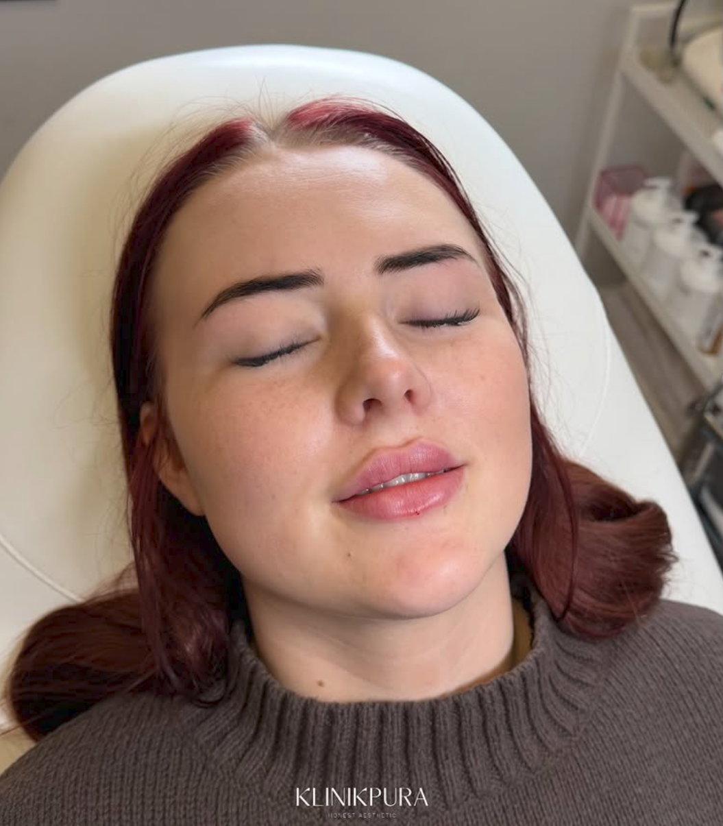 Resultat af fillerbehandling hos Klinik Pura