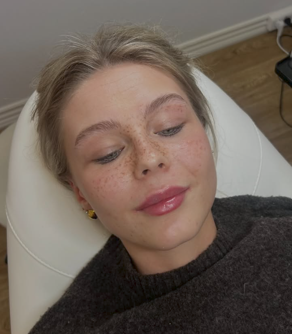 Efter billede af fillerbehandling hos Klinik Pura