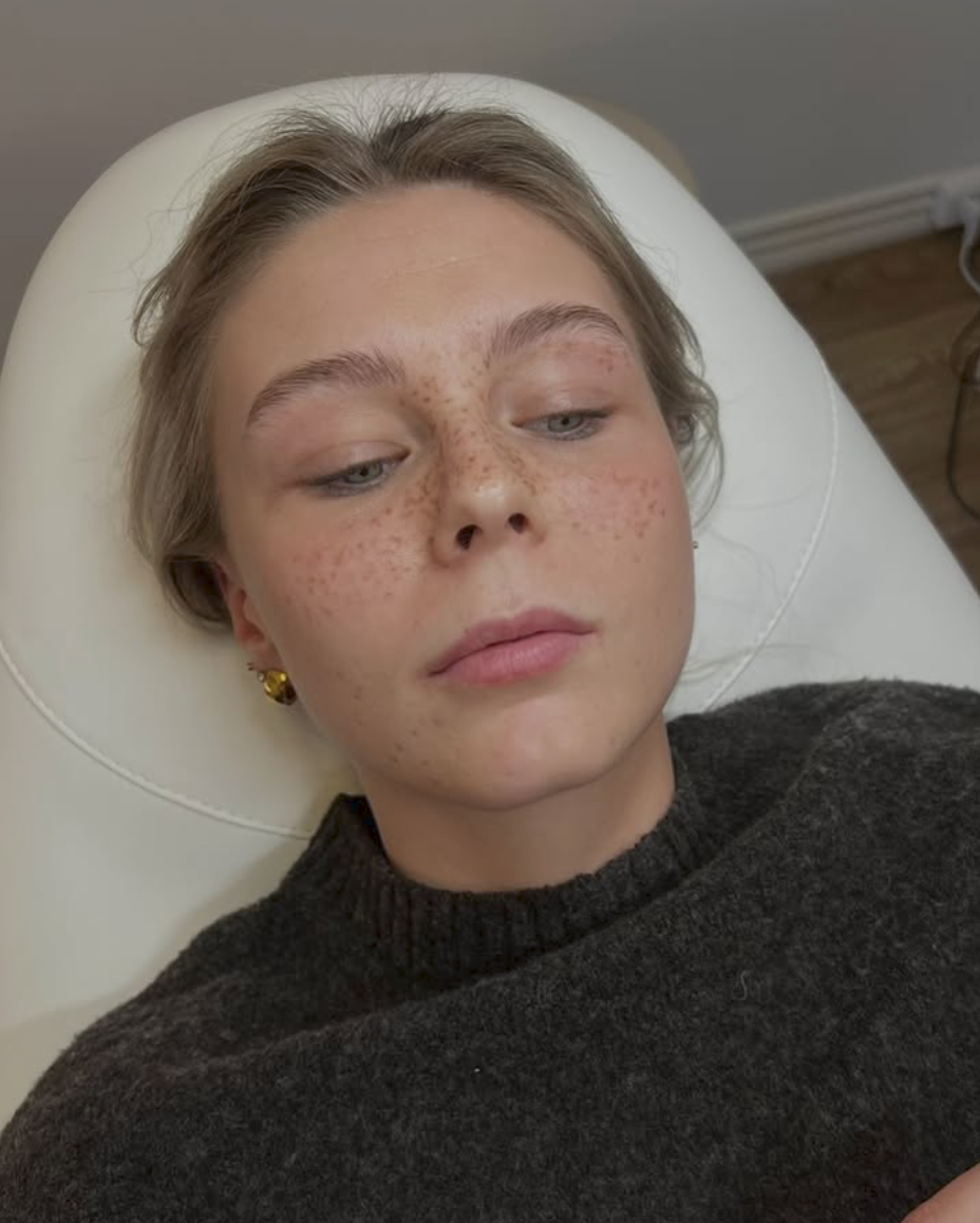 Før billede af fillerbehandling hos Klinik Pura