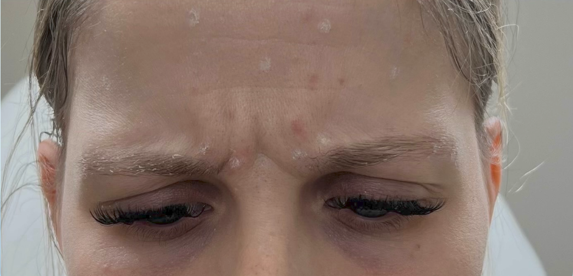 Før billede 1 af botoxbehandling hos Klinik Pura